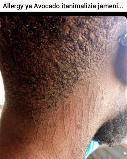 Allergy ya avocado itanimalizia jameni .
