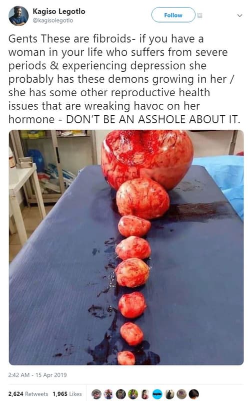Kagiso legotlo kagisolegotlo follow gents these are fibroids if you have a woman