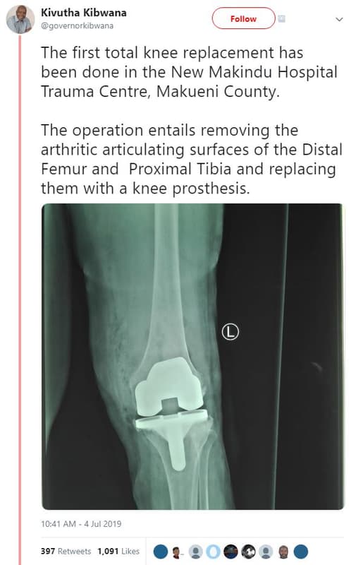 Kivutha kibwana governorkibwana follow the first total knee replacement has been