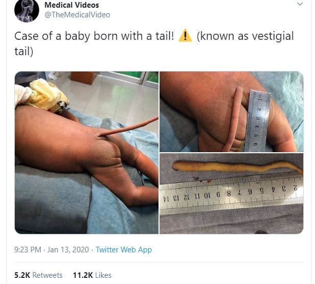 Medical videos themedicalvideo case of a baby born with a tail! tail known as ve