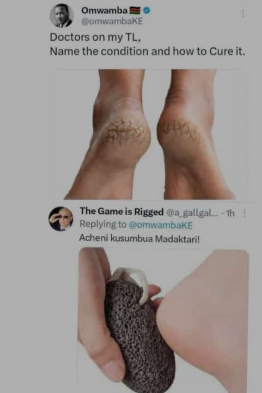 Omwamba omwambake doctors on my tl, name the condition and how to cure it. the g